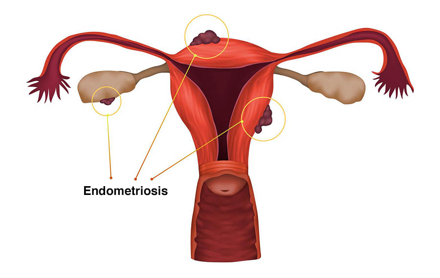 Endometriosis, illustration. A condition in which the endometrium, the layer of tissue that normally covers the inside of the uterus, grows outside of it.