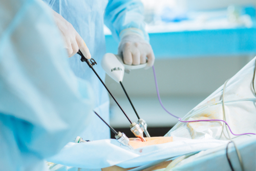 laparoscopic surgery in bangalore