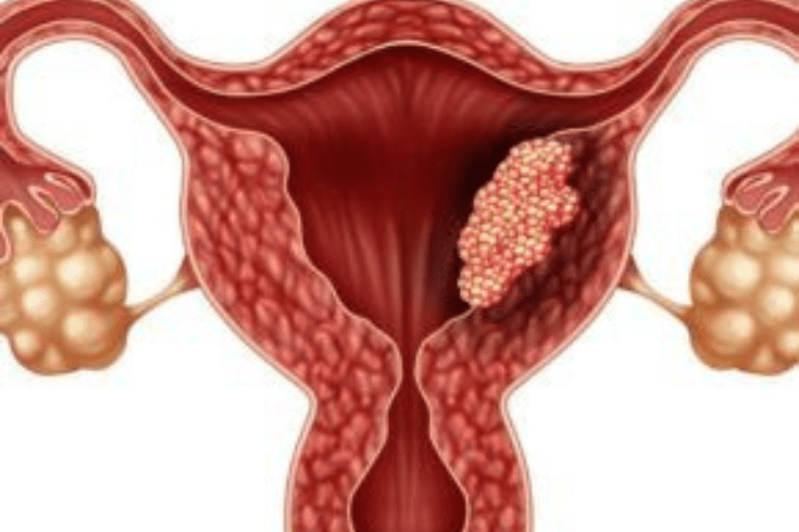 Endometrial Cancer | Srishti Speciality Clinic