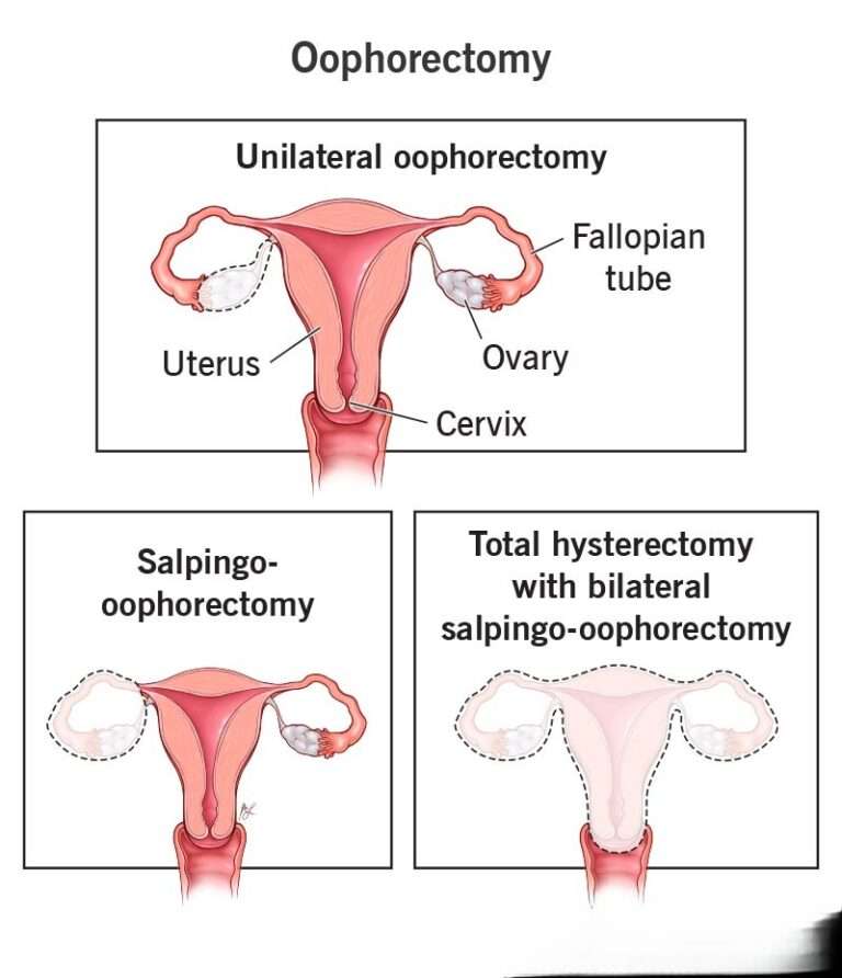 Oophorectomy | Srishti Speciality Clinic
