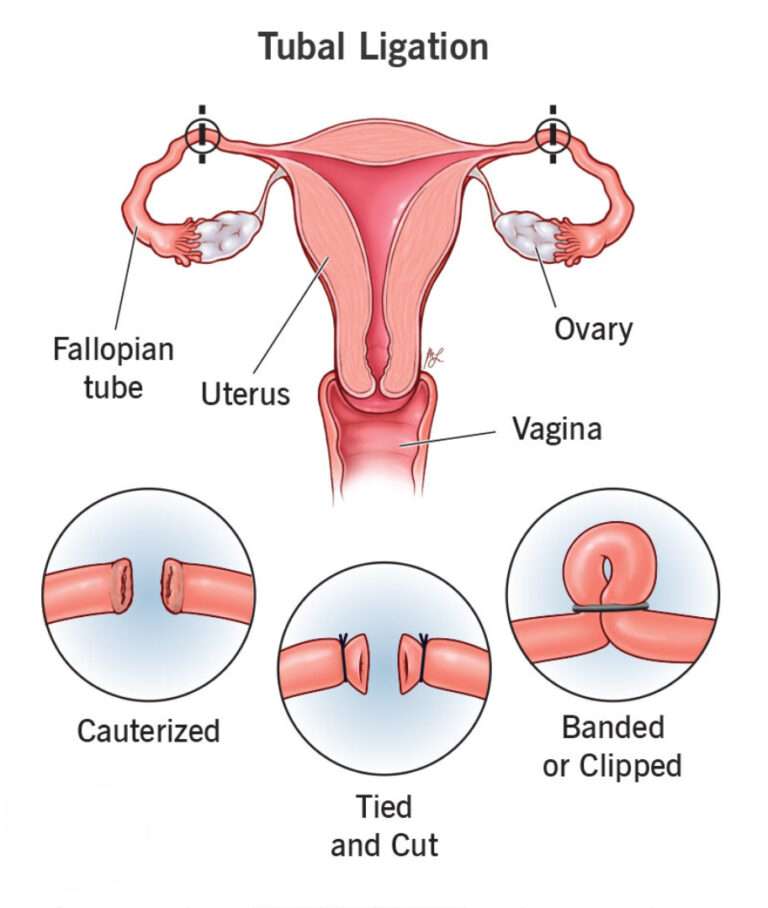 Tubal ligation | Srishti Speciality Clinic