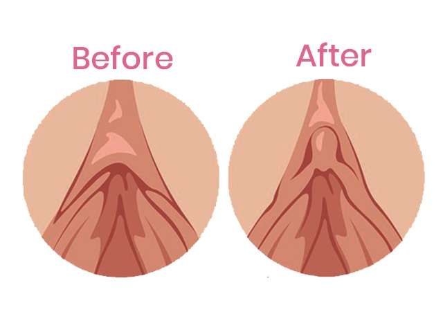 Clitorial Hoodoplasty | Srishti Speciality Clinic