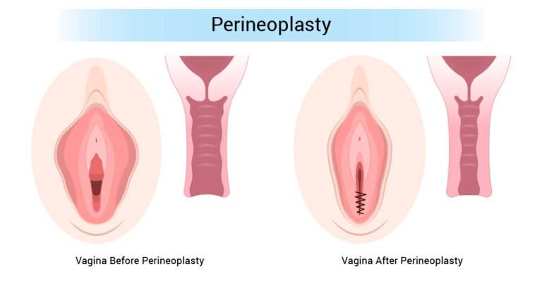 Perineoplasty Surgery | Srishti Speciality Clinic