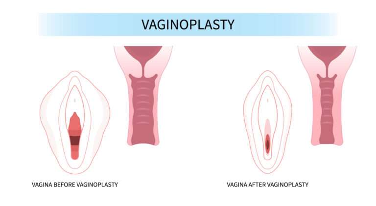 Vaginoplasty Surgery | Srishti Speciality Clinic