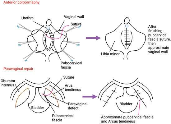 Colporrhaphy | Srishti Speciality Clinic