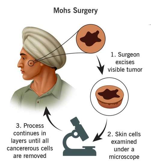 Mohs Surgery | Srishti Speciality Clinic